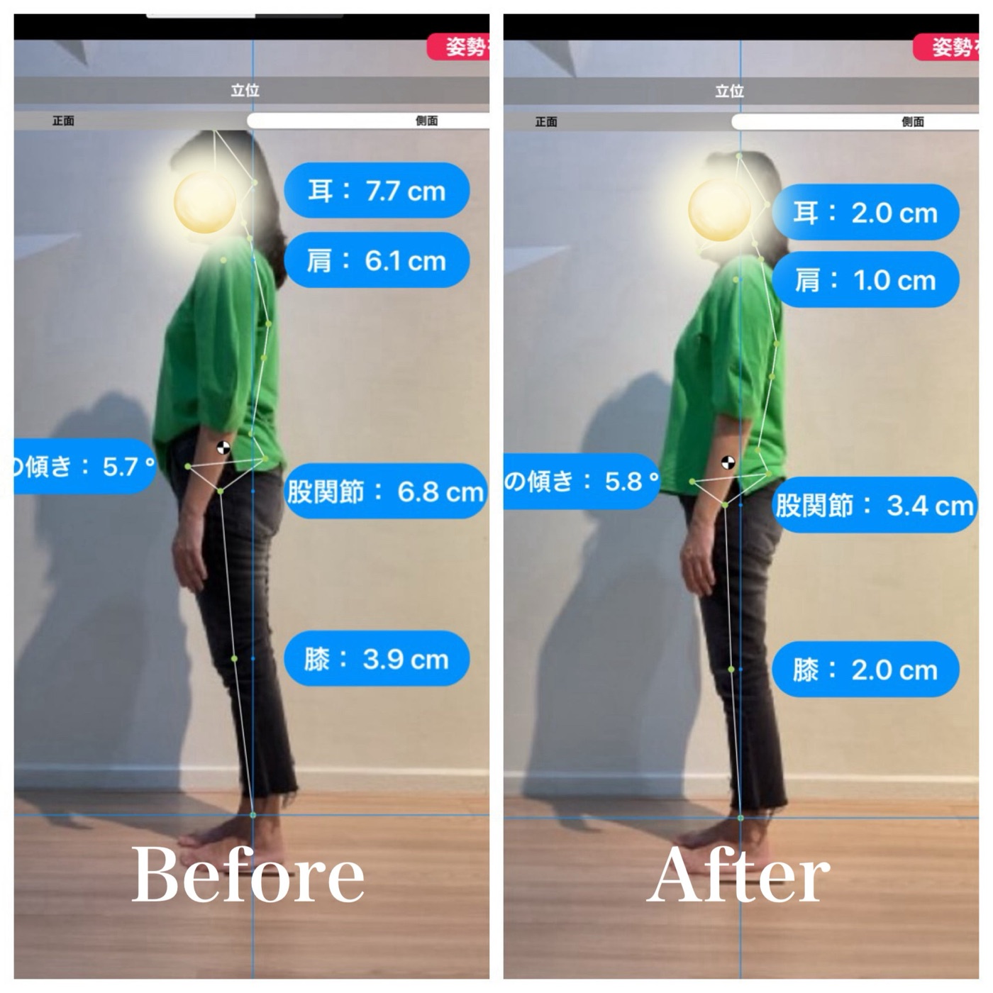 AI姿勢検査による施術前後の比較